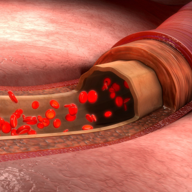 Lack  of Healthy Blood Flow.